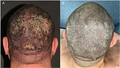 Considerations on Immunization and Immunosuppression of Patients With Autoimmune Blistering Diseases During COVID-19 Pandemic in Brazil: Case Report